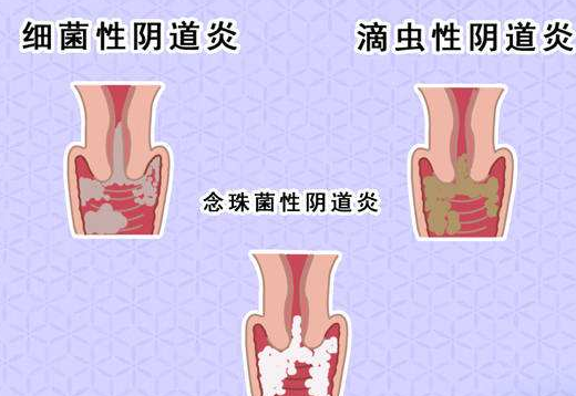 阴道分泌物幸福宝APP污版下载剖析什么是细菌性阴道炎