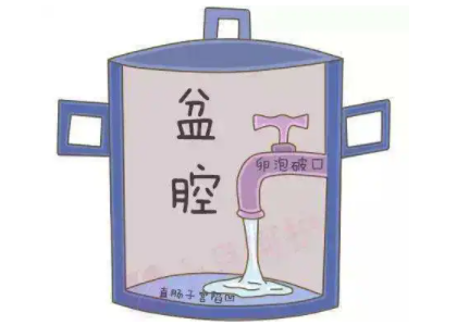 盆腔积液是怎么回事？白带幸福宝APP最新地址厂家提醒早了解早预防