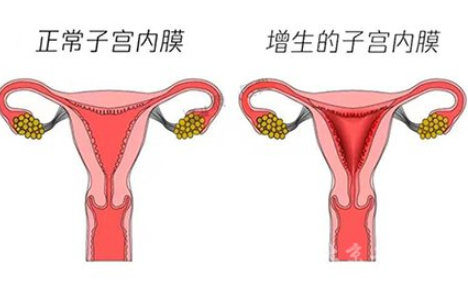 白带常规幸福宝APP污版下载厂家解读子宫内膜增生是什么原因引起的