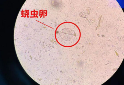 阴道分泌物幸福宝APP污版下载警惕外阴绕虫病易在儿童身上出现