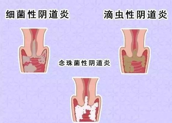 全自动阴道分泌物幸福宝APP污版下载厂家提醒您还在拖延吗，还在等阴道炎自愈吗？